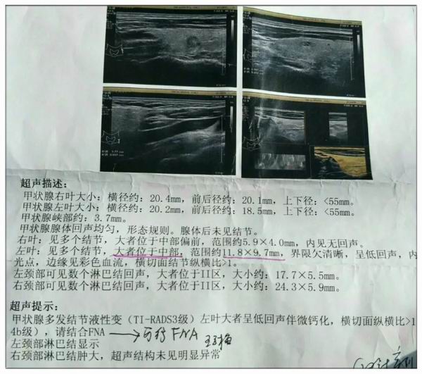 体检发现甲状腺结节,请找核医学科