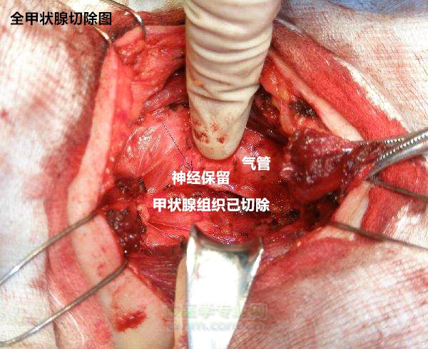 真相:甲状腺癌131碘治疗前需要"全甲状腺切除?