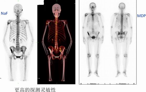 科普周刊147期】骨显像的“2.0版本”－18F-NaF PET/CT骨显像- 核医学专业网